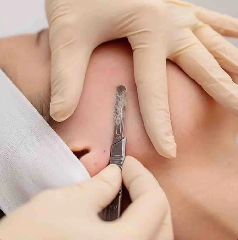 Just Dermaplaning